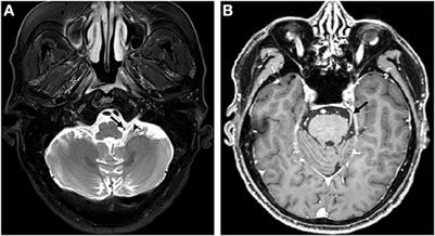 Case report: Trigeminal neuralgia misdiagnosed as glossopharyngeal neuralgia